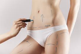 Esclarea dvidas sobre a abdominoplastia